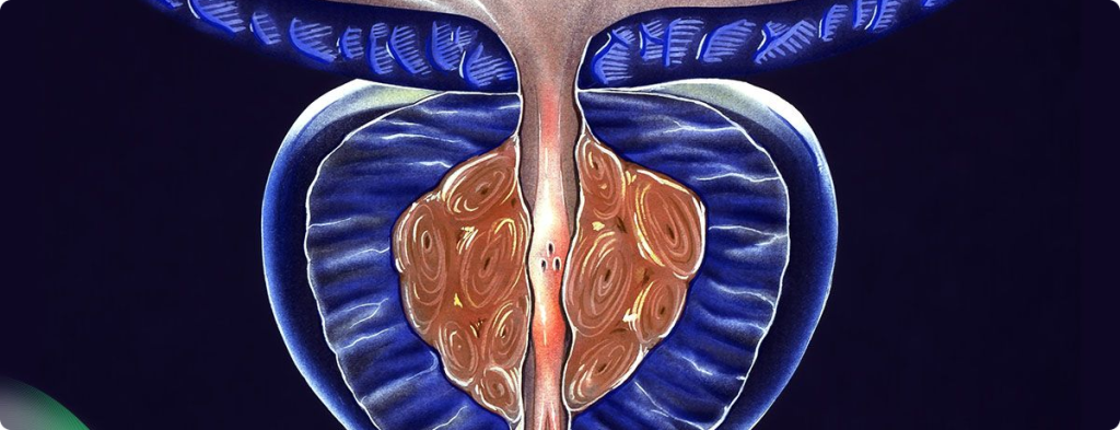 hiperplasia-header