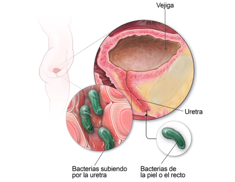 infeccion-urinaria-mid-1